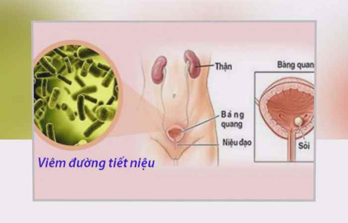 Sống khỏe 360 -  Viêm đường tiết niệu ở nữ giới  (08-07-2020)